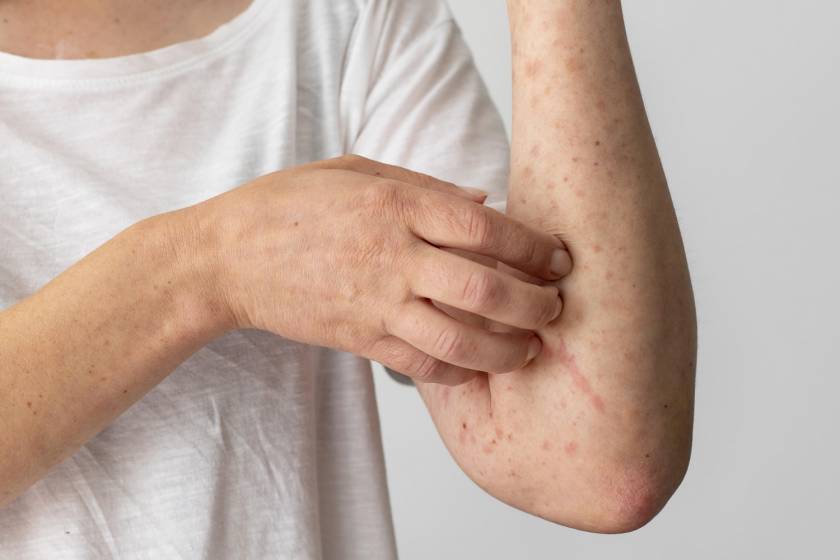  Allergies/ Eczema