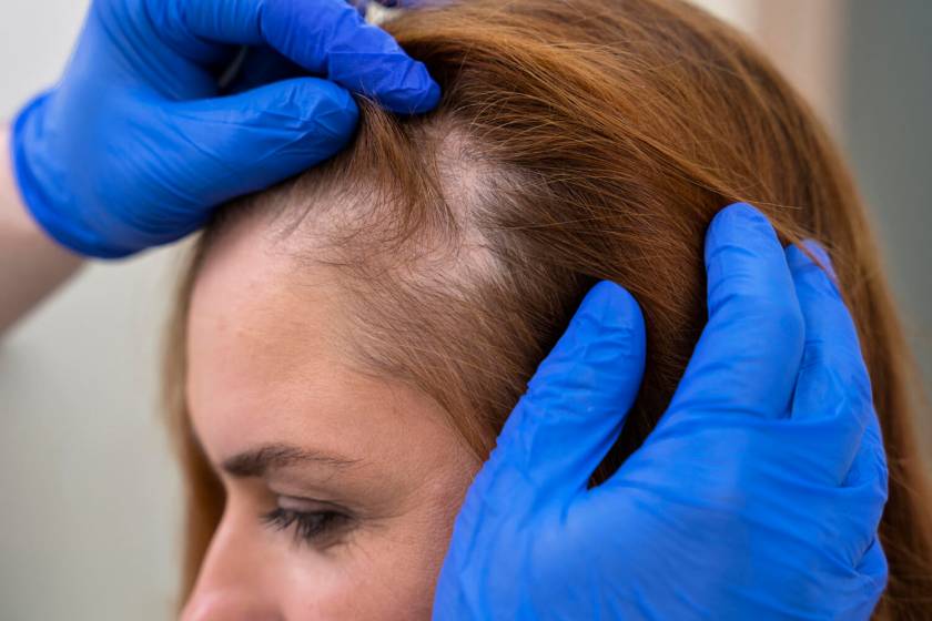 Alopecia Areata