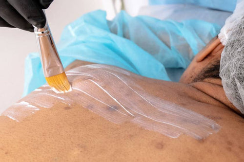 Body Acne