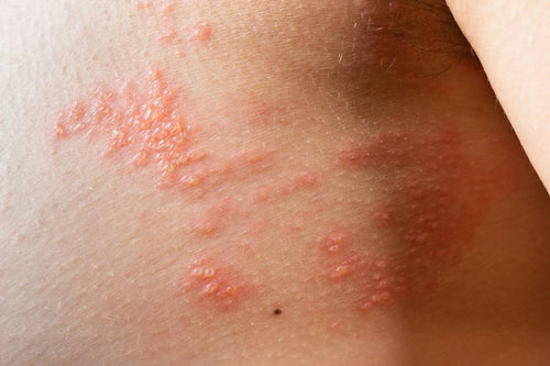 Herpes
