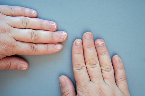 Nail Disorders