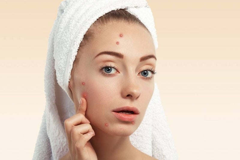Say Goodbye to Acne: Your Ultimate Guide to Clear Skin with Iksana Wellness