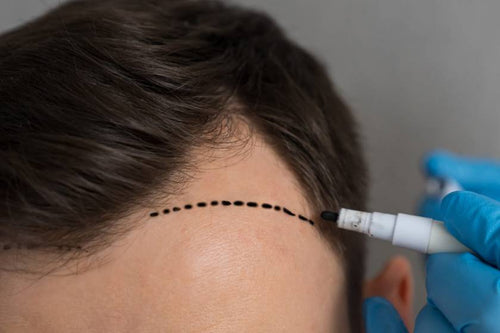 Scalp Micropigmentation