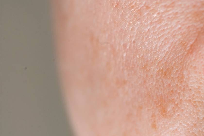 Open Pores