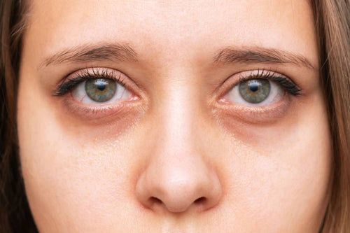 Under Eye Hollowness