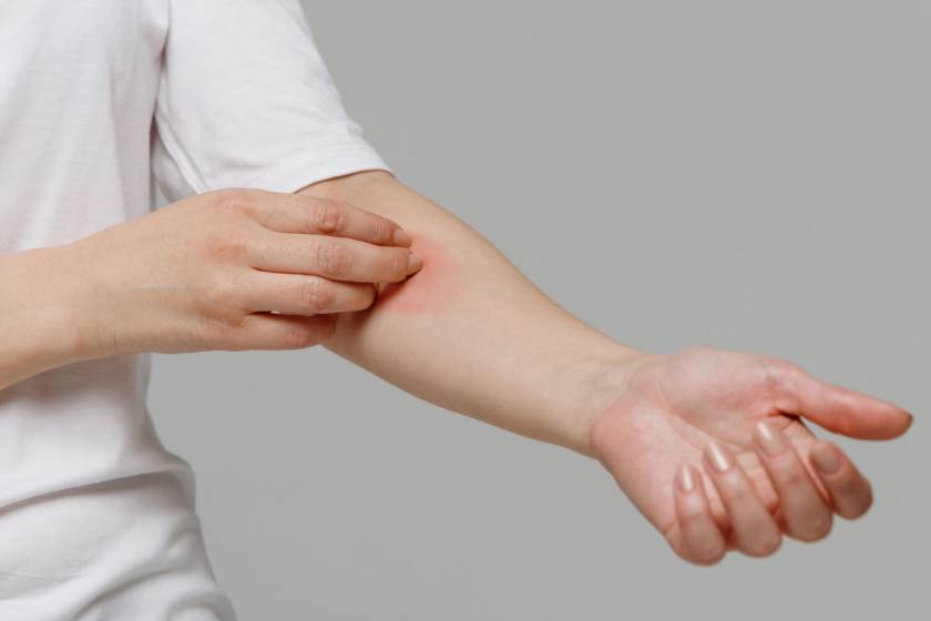 Urticaria