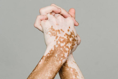 Vitiligo