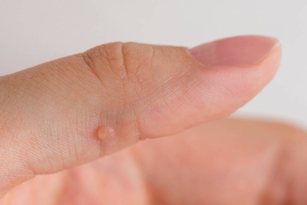 Wart