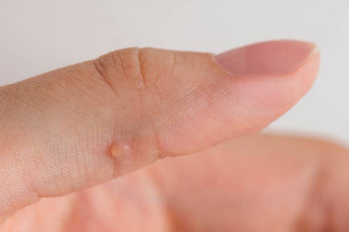 Wart