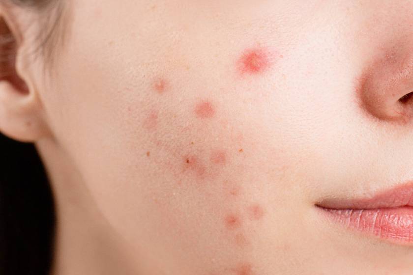 Active ACNE