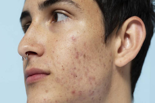 Acne Spots