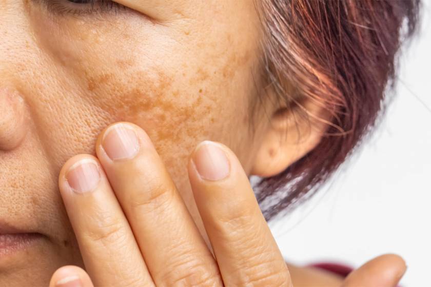 Melasma
