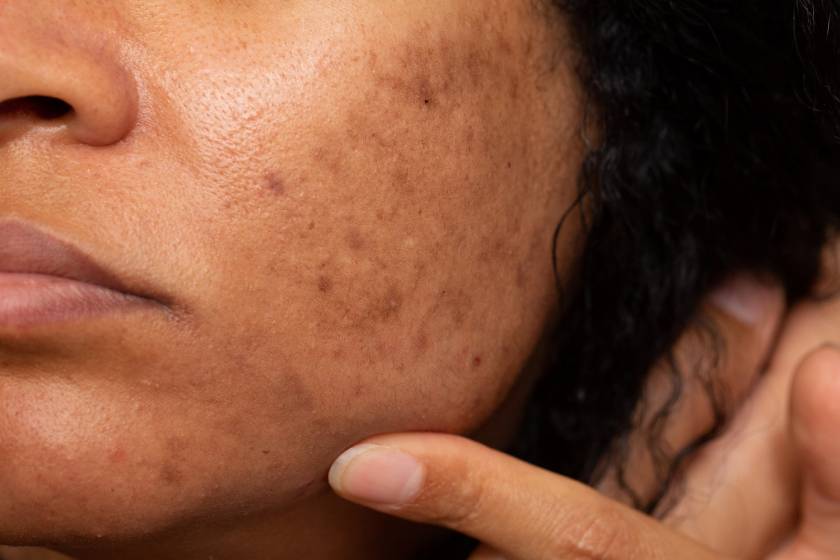 Blackheads