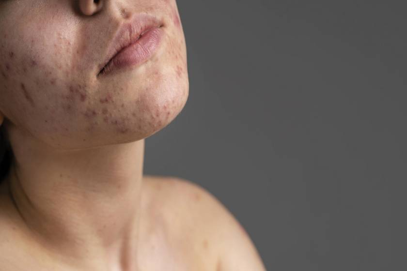 Body Acne
