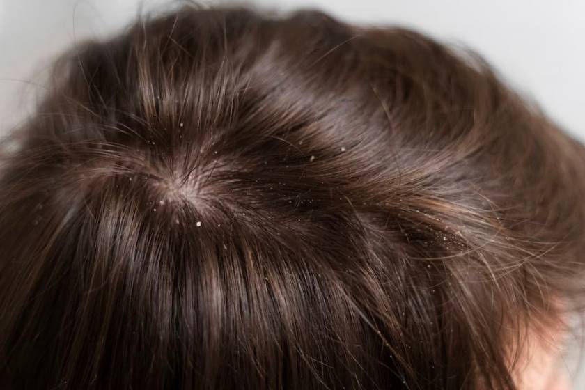 Dandruff